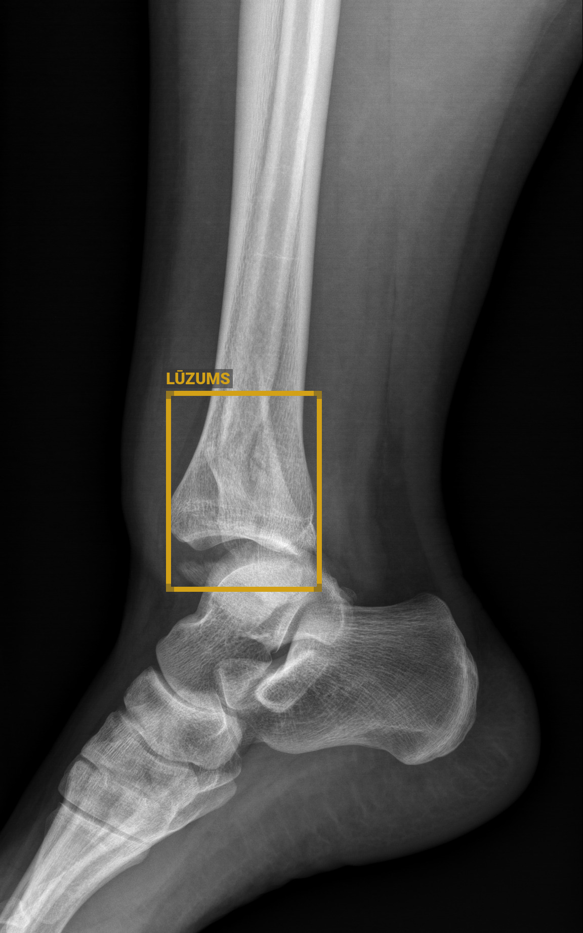 rentgena attēlā ar mākslīgā intelekta palīdzību precizēts kājas lūzums